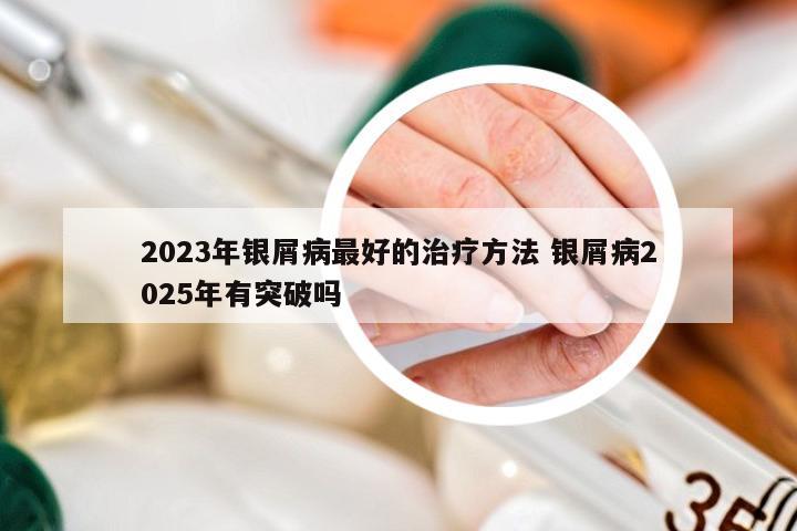 2023年银屑病最好的治疗方法 银屑病2025年有突破吗