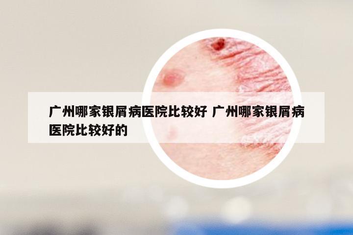 广州哪家银屑病医院比较好 广州哪家银屑病医院比较好的