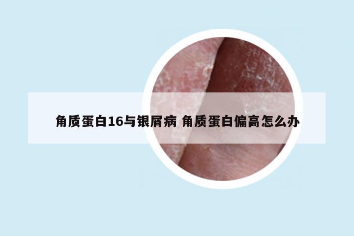 角质蛋白16与银屑病 角质蛋白偏高怎么办