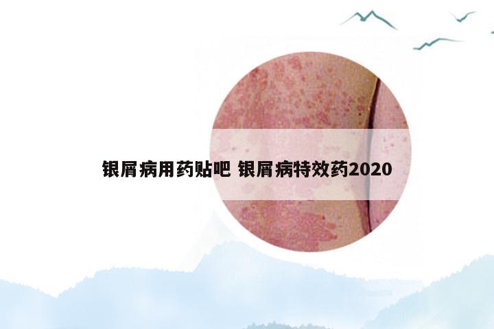 银屑病用药贴吧 银屑病特效药2020