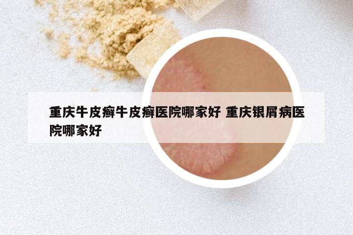 重庆牛皮癣牛皮癣医院哪家好 重庆银屑病医院哪家好