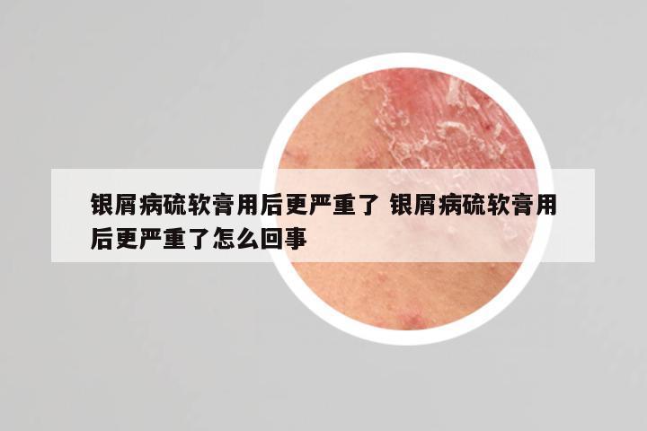 银屑病硫软膏用后更严重了 银屑病硫软膏用后更严重了怎么回事