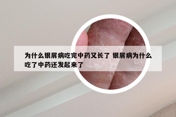 为什么银屑病吃完中药又长了 银屑病为什么吃了中药还发起来了