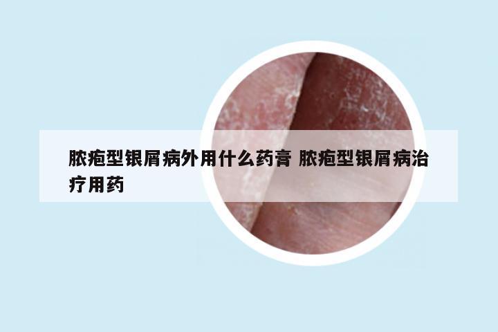 脓疱型银屑病外用什么药膏 脓疱型银屑病治疗用药