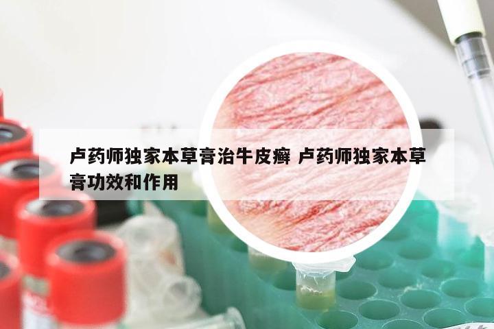 卢药师独家本草膏治牛皮癣 卢药师独家本草膏功效和作用