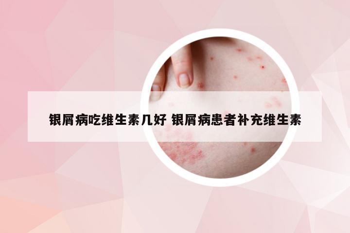 银屑病吃维生素几好 银屑病患者补充维生素