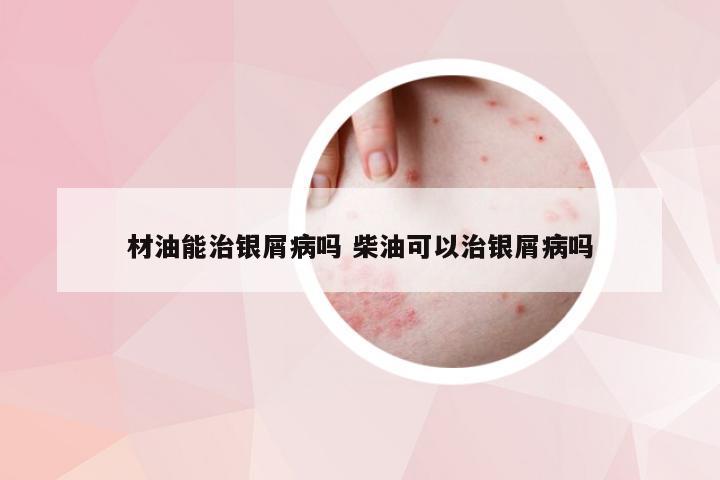 材油能治银屑病吗 柴油可以治银屑病吗