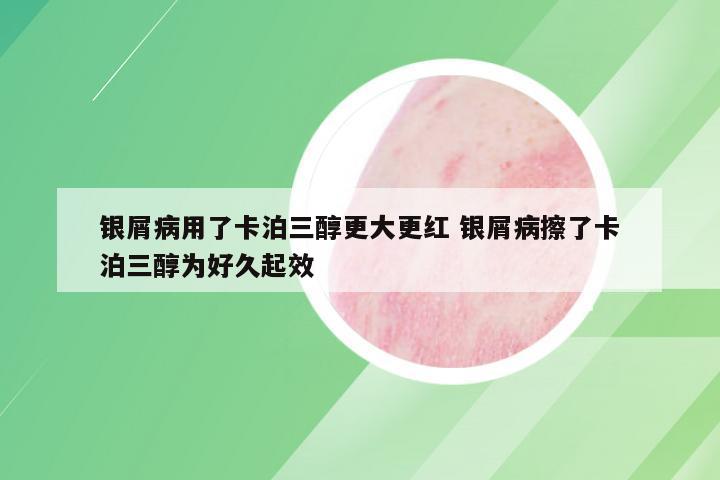 银屑病用了卡泊三醇更大更红 银屑病擦了卡泊三醇为好久起效