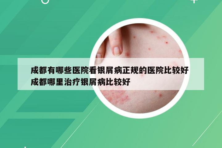 成都有哪些医院看银屑病正规的医院比较好 成都哪里治疗银屑病比较好