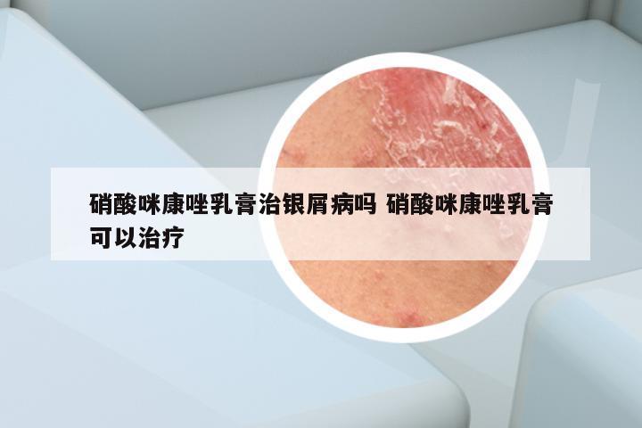 硝酸咪康唑乳膏治银屑病吗 硝酸咪康唑乳膏可以治疗