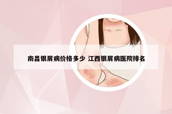 南昌银屑病价格多少 江西银屑病医院排名