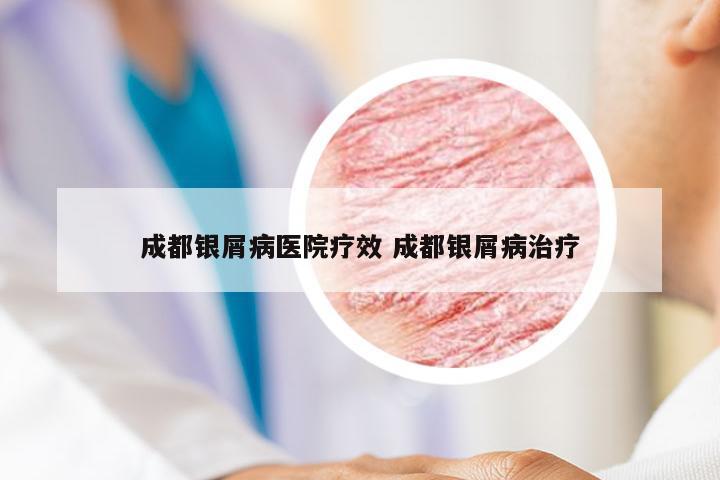 成都银屑病医院疗效 成都银屑病治疗