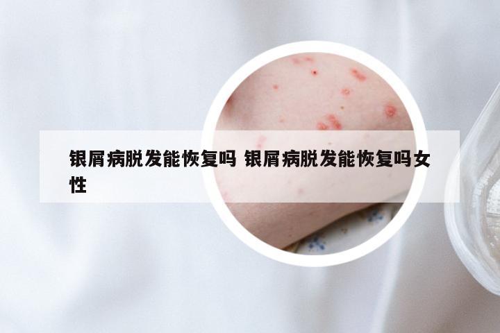 银屑病脱发能恢复吗 银屑病脱发能恢复吗女性