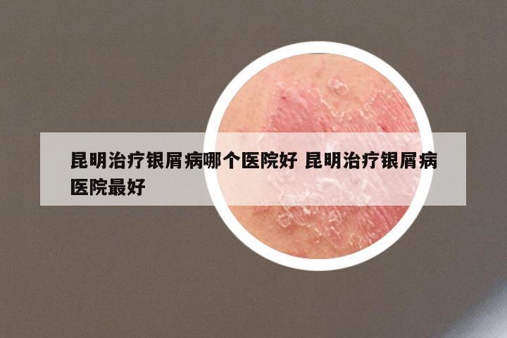 昆明治疗银屑病哪个医院好 昆明治疗银屑病医院最好