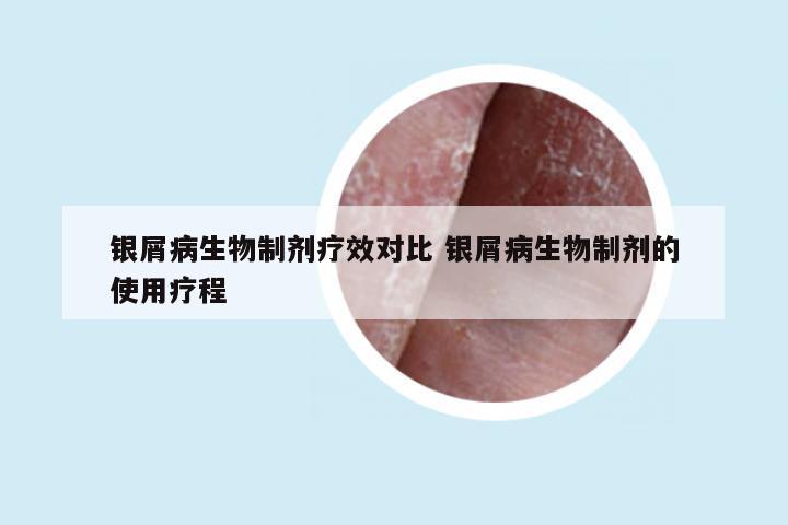 银屑病生物制剂疗效对比 银屑病生物制剂的使用疗程