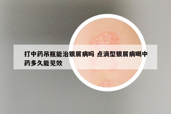 打中药吊瓶能治银屑病吗 点滴型银屑病喝中药多久能见效