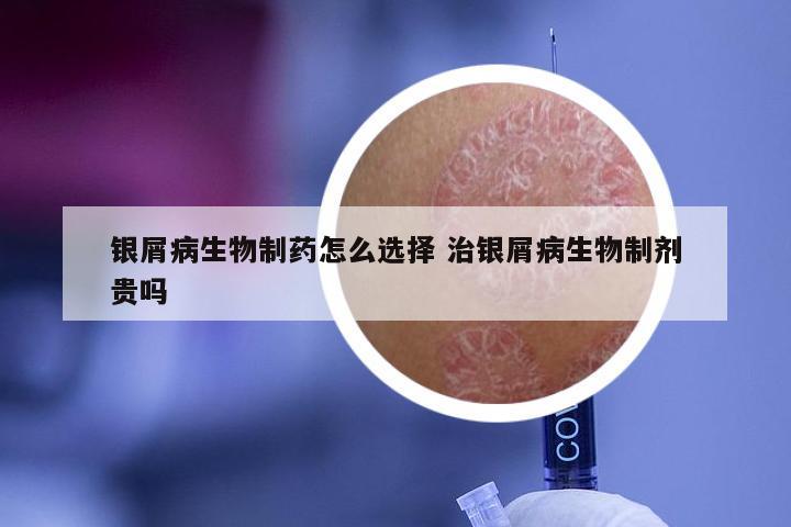 银屑病生物制药怎么选择 治银屑病生物制剂贵吗