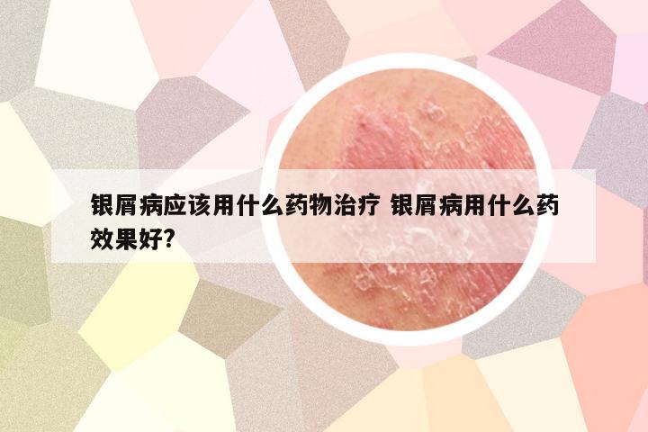 银屑病应该用什么药物治疗 银屑病用什么药效果好?