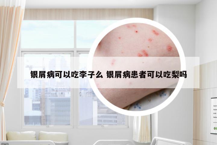 银屑病可以吃李子么 银屑病患者可以吃梨吗