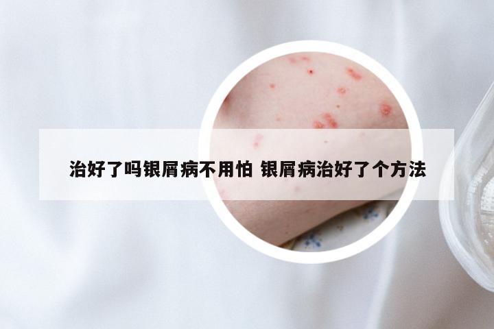 治好了吗银屑病不用怕 银屑病治好了个方法