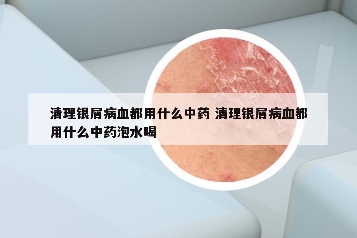 清理银屑病血都用什么中药 清理银屑病血都用什么中药泡水喝