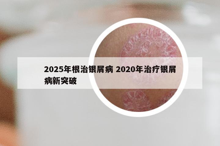 2025年根治银屑病 2020年治疗银屑病新突破