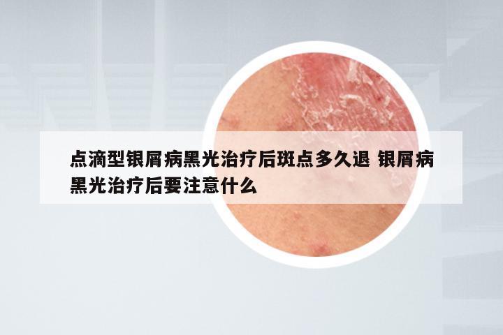 点滴型银屑病黑光治疗后斑点多久退 银屑病黑光治疗后要注意什么