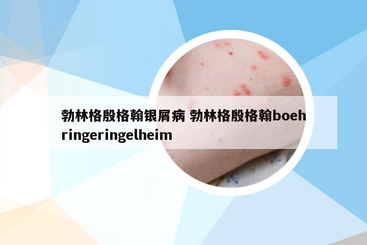 勃林格殷格翰银屑病 勃林格殷格翰boehringeringelheim