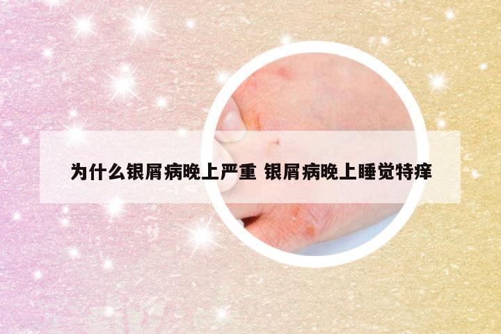 为什么银屑病晚上严重 银屑病晚上睡觉特痒