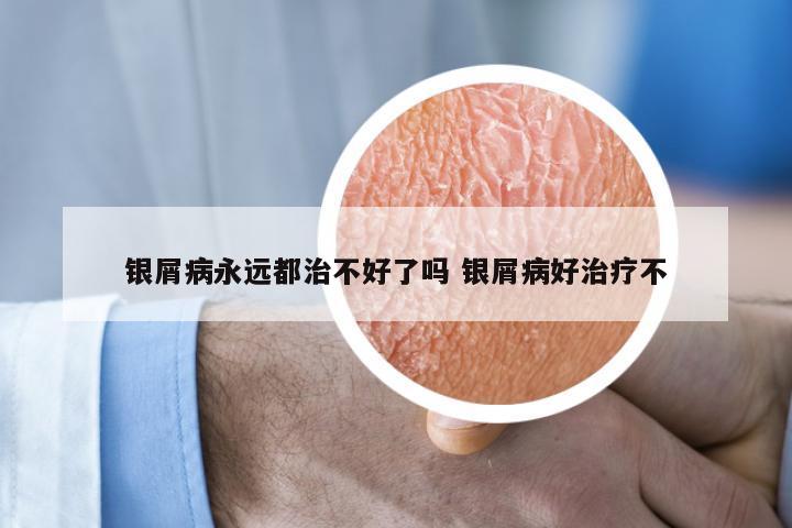 银屑病永远都治不好了吗 银屑病好治疗不