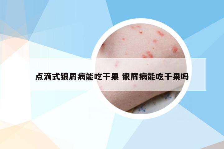 点滴式银屑病能吃干果 银屑病能吃干果吗