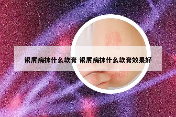 银屑病抹什么软膏 银屑病抹什么软膏效果好