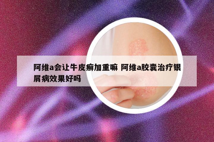 阿维a会让牛皮癣加重嘛 阿维a胶囊治疗银屑病效果好吗