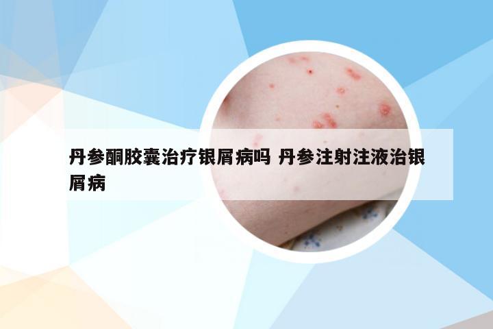 丹参酮胶囊治疗银屑病吗 丹参注射注液治银屑病