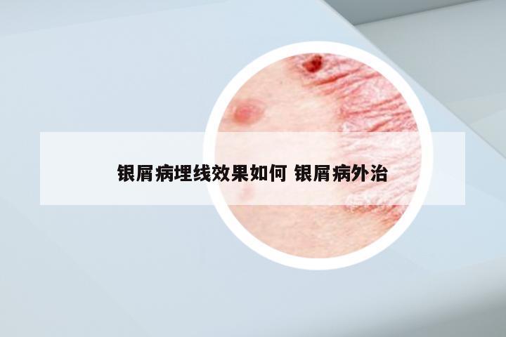 银屑病埋线效果如何 银屑病外治