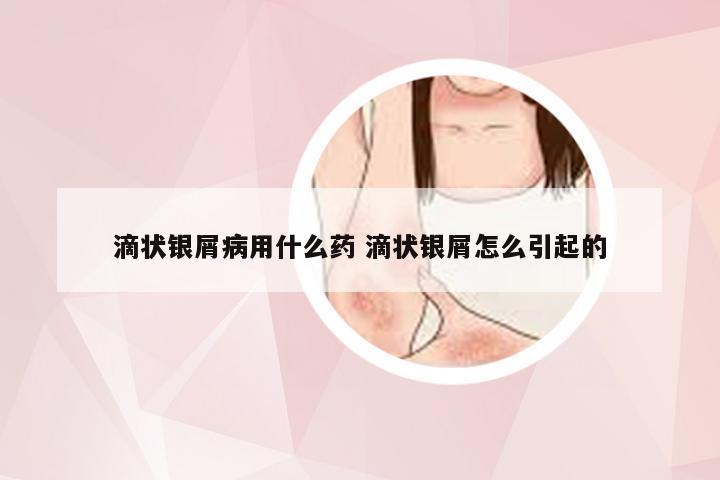 滴状银屑病用什么药 滴状银屑怎么引起的