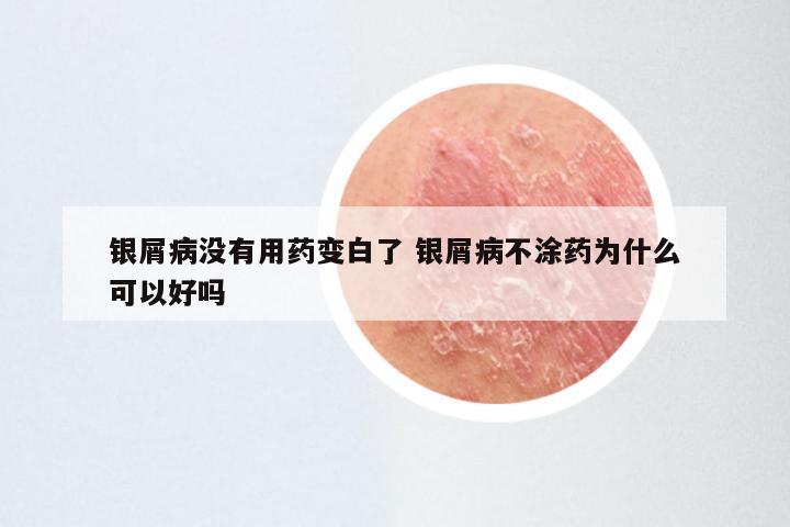 银屑病没有用药变白了 银屑病不涂药为什么可以好吗