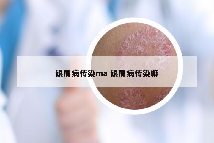 银屑病传染ma 银屑病传染嘛