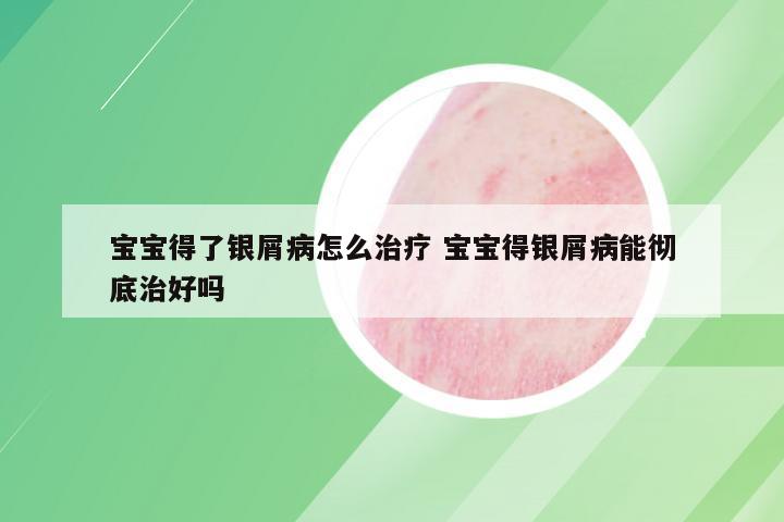 宝宝得了银屑病怎么治疗 宝宝得银屑病能彻底治好吗