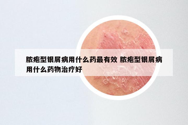 脓疱型银屑病用什么药最有效 脓疱型银屑病用什么药物治疗好