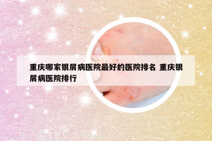 重庆哪家银屑病医院最好的医院排名 重庆银屑病医院排行