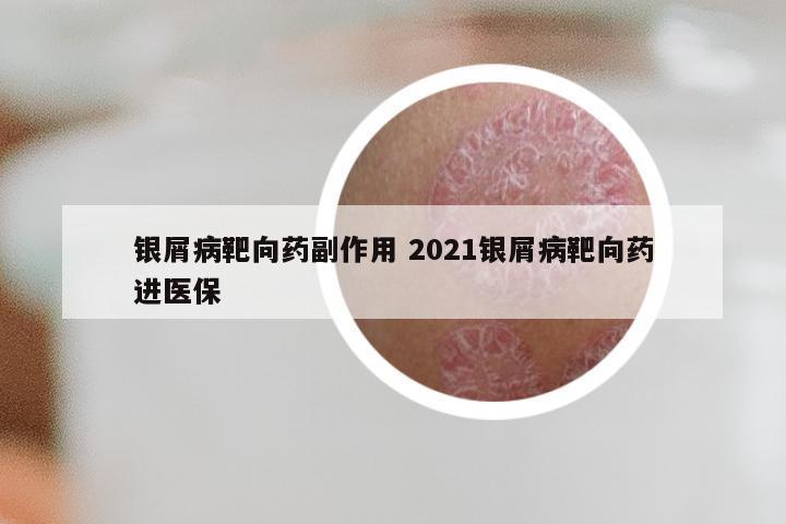 银屑病靶向药副作用 2021银屑病靶向药进医保