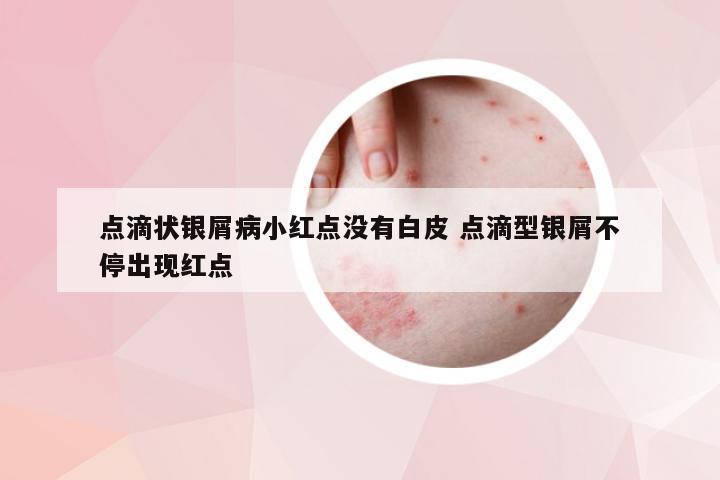 点滴状银屑病小红点没有白皮 点滴型银屑不停出现红点