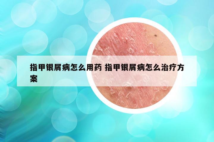 指甲银屑病怎么用药 指甲银屑病怎么治疗方案