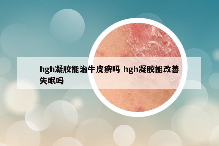 hgh凝胶能治牛皮癣吗 hgh凝胶能改善失眠吗