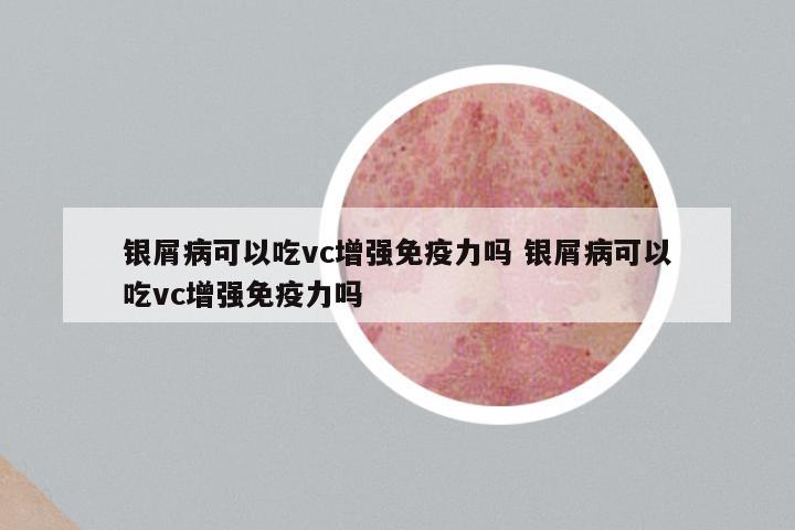 银屑病可以吃vc增强免疫力吗 银屑病可以吃vc增强免疫力吗