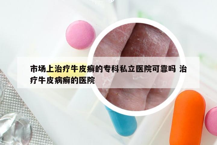 市场上治疗牛皮癣的专科私立医院可靠吗 治疗牛皮病癣的医院