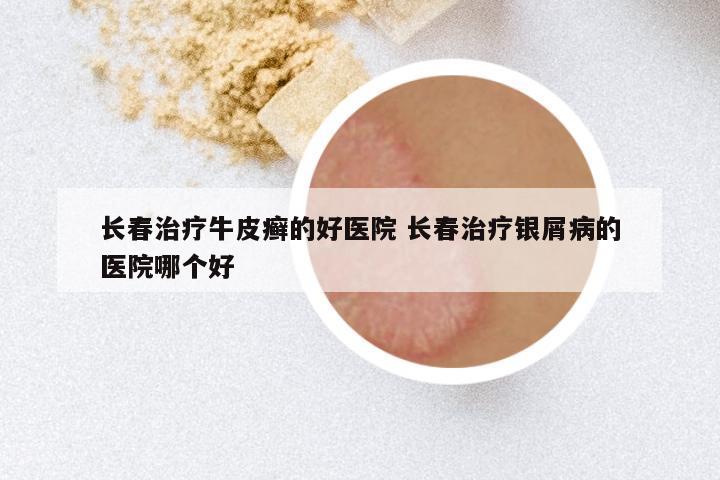 长春治疗牛皮癣的好医院 长春治疗银屑病的医院哪个好