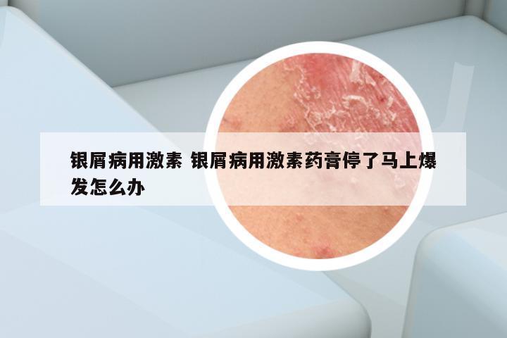 银屑病用激素 银屑病用激素药膏停了马上爆发怎么办