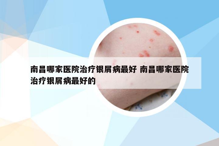 南昌哪家医院治疗银屑病最好 南昌哪家医院治疗银屑病最好的